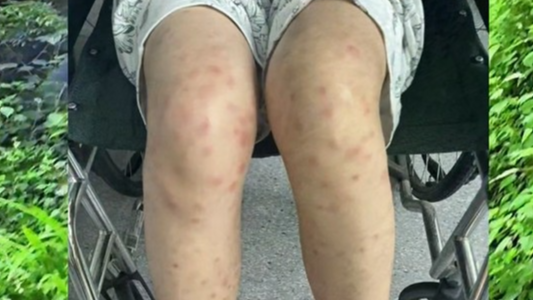 浙江一女子爬山归来莫名高热出疹 医生：警惕山里看不见的“虫毒”！
