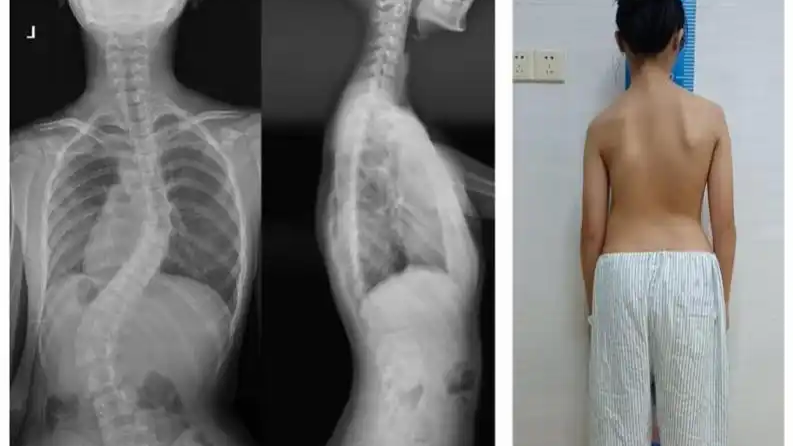 12岁女孩确诊重度脊柱侧弯！医生：别以为只是孩子体态不好