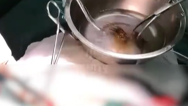手术取出6盆毛发！广东13岁少女胃里塞满头发引发‌肠梗阻‌
